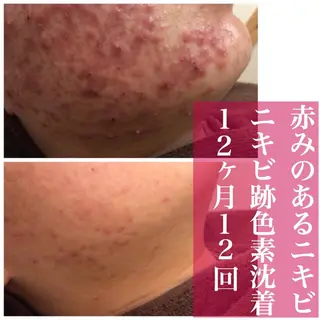 ミディアム カラー パーマ ヘアアレンジ メンズ キッズ ネイル マツエク・マツパ アイブロウ ニキビ・肌質改善専門 ♡人生が変わるサロンのエステ・リラクイメージ