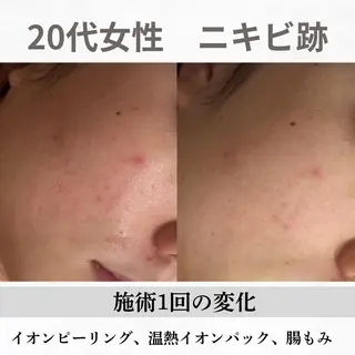 重度ニキビ専門🌼 ダウンタイムなしのエステ・リラクイメージ