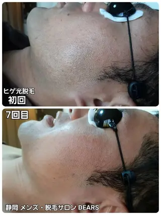 メンズ 山村幸久 メンズ脱毛 ディアーズのエステ・リラクイメージ