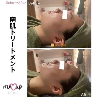Meupニキビ専門店 背中/ハーブ/肌管理のその他イメージ