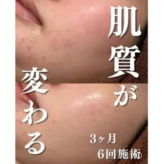 3か月で肌革命👼 ニキビ専門店💫のエステ・リラクイメージ