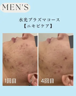 メンズ 小顔＆肌質改善 NICORIのエステ・リラクイメージ