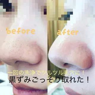 肌質改善Lino 毛穴・ニキビケア専門のエステ・リラクイメージ