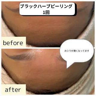 【ハーブピーリング】 Allumentのエステ・リラクイメージ
