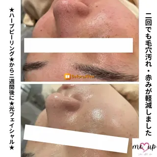 Meupニキビ専門店 背中/ハーブ/肌管理のその他イメージ