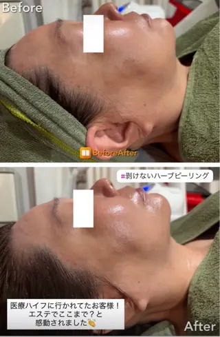 Meupニキビ専門店 背中/ハーブ/肌管理のその他イメージ