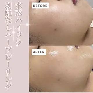 水素ハイドラ/脱毛 /ハーブピーリングのその他イメージ