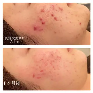 ミディアム カラー パーマ ヘアアレンジ メンズ キッズ ネイル マツエク・マツパ ニキビ跡専門サロン Ainaのエステ・リラクイメージ