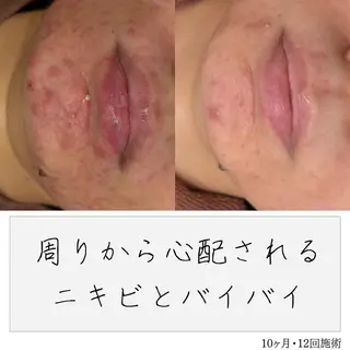 ニキビ経験者が施術 する専門サロン🌻のエステ・リラクイメージ