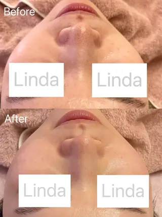 小顔&毛穴・肌質改善 LINDA西宮 AIのエステ・リラクイメージ