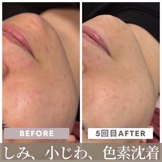 小顔矯正・ニキビケア 池田 桃花のエステ・リラクイメージ