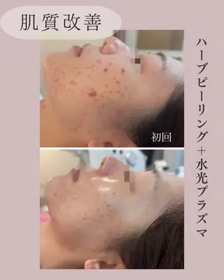 小顔＆肌質改善 NICORIのエステ・リラクイメージ