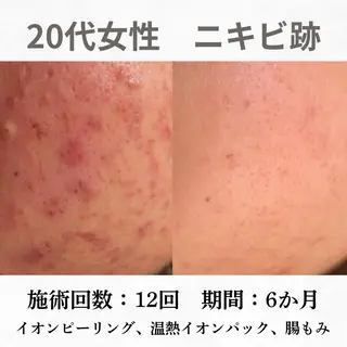重度ニキビ専門🌼 ダウンタイムなしのエステ・リラクイメージ