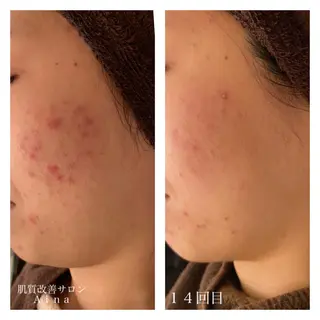 セミロング カラー パーマ ヘアアレンジ メンズ キッズ ネイル マツエク・マツパ ニキビ跡専門サロン Ainaのエステ・リラクイメージ