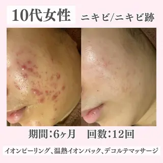 ニキビ・肌質改善専門 ♡人生が変わるサロンのエステ・リラクイメージ