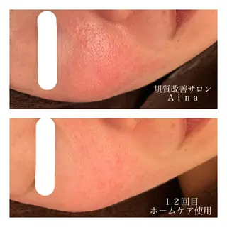 セミロング カラー パーマ ヘアアレンジ メンズ キッズ ネイル マツエク・マツパ ニキビ跡専門サロン Ａｉｎａのエステ・リラクイメージ