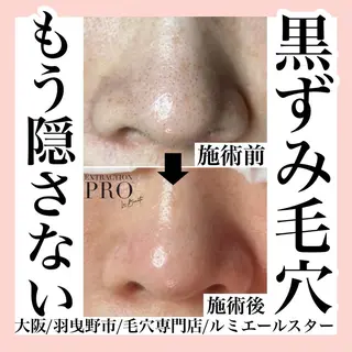 最速 毛穴シミ改善 いくえのその他イメージ