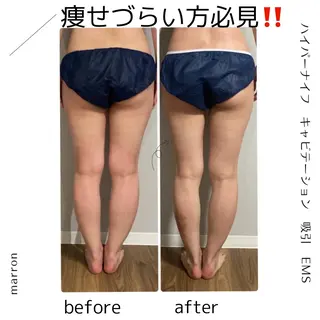 痩身ハイパーナイフ ララピールリアボーテのエステ・リラクイメージ