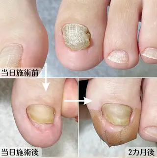 ネイル 巻き爪・肥厚爪ケア 専門サンセリテのネイルデザイン