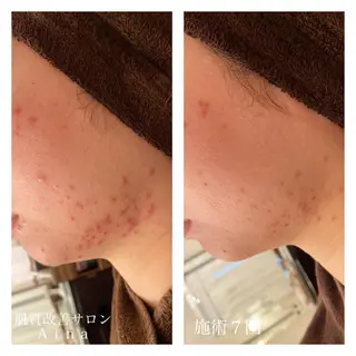 ミディアム カラー パーマ ヘアアレンジ メンズ ネイル マツエク・マツパ ニキビ跡専門サロン Ainaのエステ・リラクイメージ