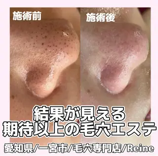 毛穴/シミ肝斑/脱毛 横山梨里のエステ・リラクイメージ