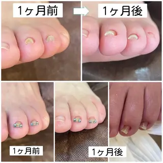 ネイル ♢ME2ROOM♢ #巻き爪#リラクのネイルデザイン