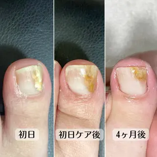 ネイル 巻き爪・肥厚爪ケア 専門サンセリテのネイルデザイン