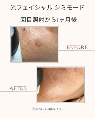 メンズ Felice🌸脱毛 ・光フェイシャルのその他イメージ