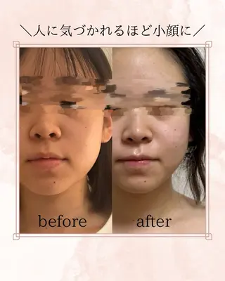 美容鍼WINBACK サロンRemeのエステ・リラクイメージ