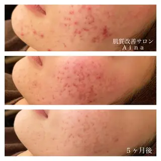 セミロング カラー パーマ ヘアアレンジ メンズ キッズ ネイル マツエク・マツパ ニキビ跡専門サロン Ainaのエステ・リラクイメージ