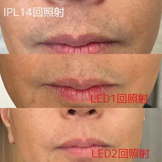 脱毛 yukinoのエステ・リラクイメージ