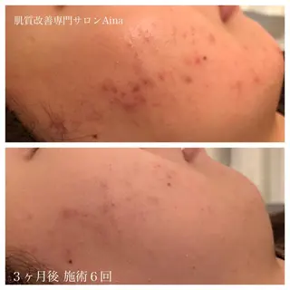 セミロング パーマ メンズ キッズ ネイル マツエク・マツパ ニキビ跡専門サロン Ainaのエステ・リラクイメージ