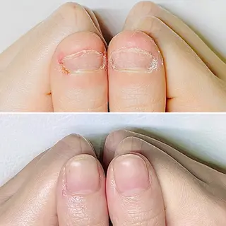 ネイル 巻き爪・肥厚爪ケア 専門サンセリテのネイルデザイン