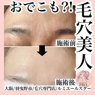 最速 毛穴シミ改善 いくえのその他イメージ