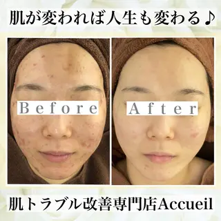 ミディアム カラー パーマ ヘアアレンジ メンズ キッズ ネイル マツエク・マツパ ニキビ・肌質改善専門 ♡人生が変わるサロンのエステ・リラクイメージ
