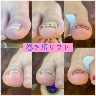 ネイル ♢ME2ROOM♢ #巻き爪#リラクのネイルデザイン