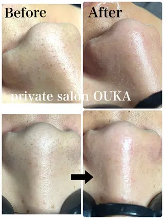 OUKA脱毛 毛穴ケアフェイシャルのエステ・リラクイメージ