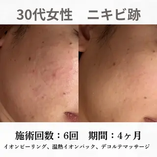 重度ニキビ専門🌷 ダウンタイムなしのエステ・リラクイメージ