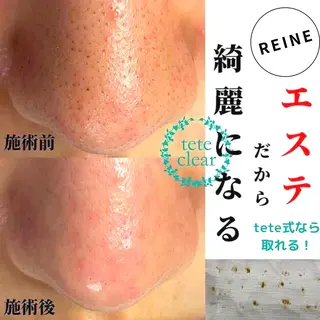 毛穴/シミ肝斑/脱毛 横山梨里のエステ・リラクイメージ