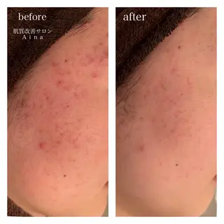 ミディアム カラー パーマ ヘアアレンジ メンズ キッズ ネイル マツエク・マツパ ニキビ跡専門サロン Ainaのエステ・リラクイメージ