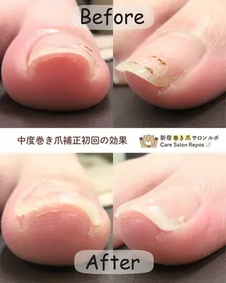 ネイル 新宿巻き爪ケア ルポのネイルデザイン
