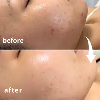 ニキビ改善エステ/ 駅1分🍯KAORIのエステ・リラクイメージ