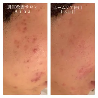 セミロング カラー パーマ ヘアアレンジ メンズ キッズ ネイル マツエク・マツパ ニキビ跡専門サロン Ainaのエステ・リラクイメージ