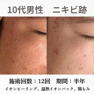 重度ニキビ専門🌼 ダウンタイムなしのエステ・リラクイメージ
