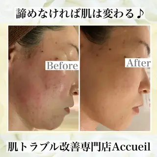 ミディアム カラー パーマ ヘアアレンジ メンズ キッズ ネイル マツエク・マツパ ニキビ・肌質改善専門 ♡人生が変わるサロンのエステ・リラクイメージ