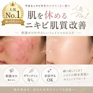 重度ニキビ専門🌼 ダウンタイムなしのエステ・リラクイメージ