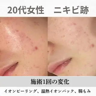 重度ニキビ専門🌼 ダウンタイムなしのエステ・リラクイメージ