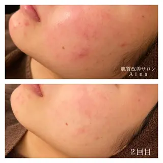 ミディアム カラー パーマ ヘアアレンジ メンズ キッズ ネイル マツエク・マツパ ニキビ跡専門サロン Ainaのエステ・リラクイメージ