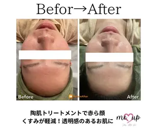 Meupニキビ専門店 背中/ハーブ/肌管理のその他イメージ