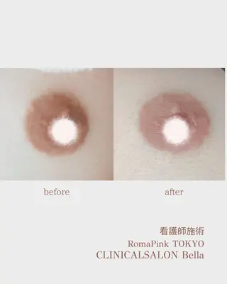 たるみほうれい線ケア 看護師サロンのエステ・リラクイメージ